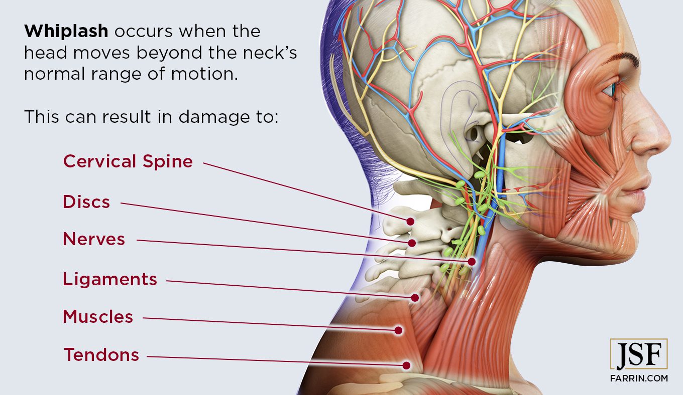 Whiplash Treatment Brisbane